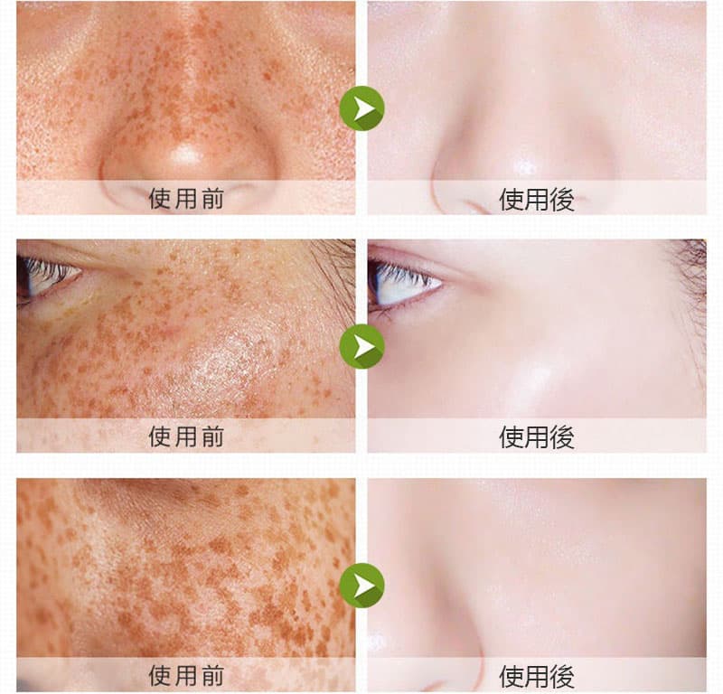OSUFI Whitening Anti-freckle Essence(২১ টি মেসতা রিমুভার ক্যাপসুল সেট)  thumb 2